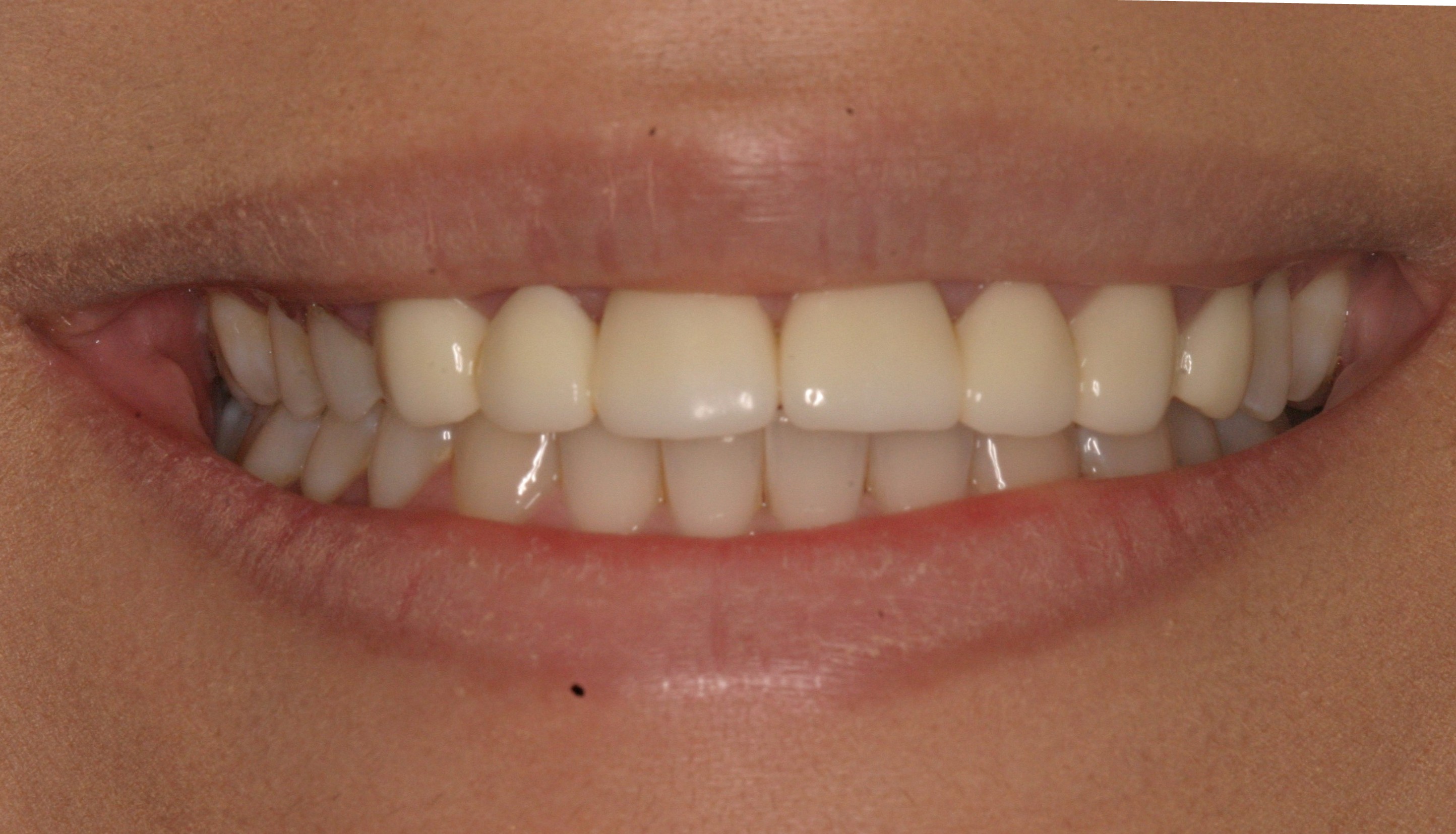 Before Invisalign Treatment