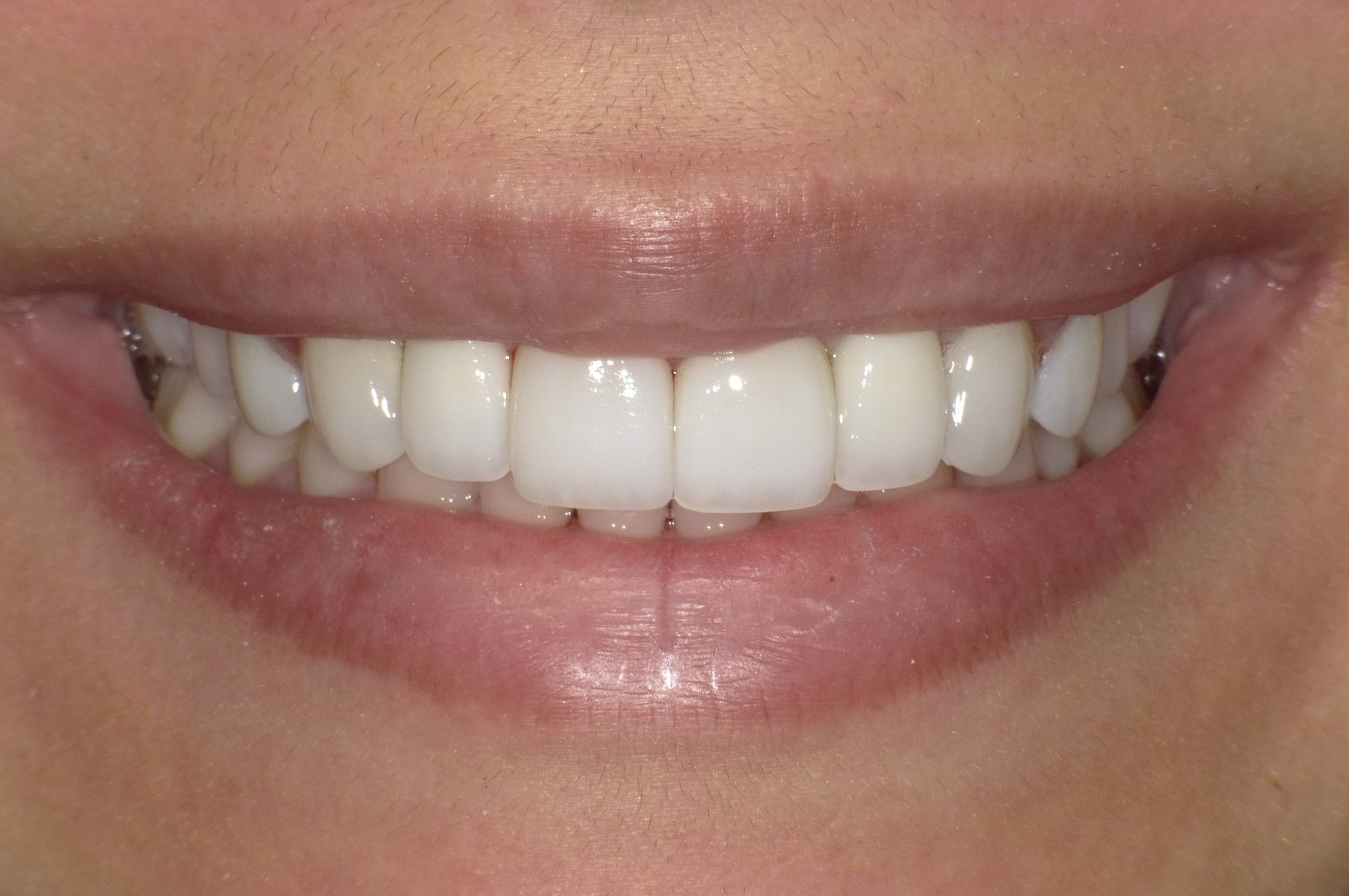 After Invisalign Treatment