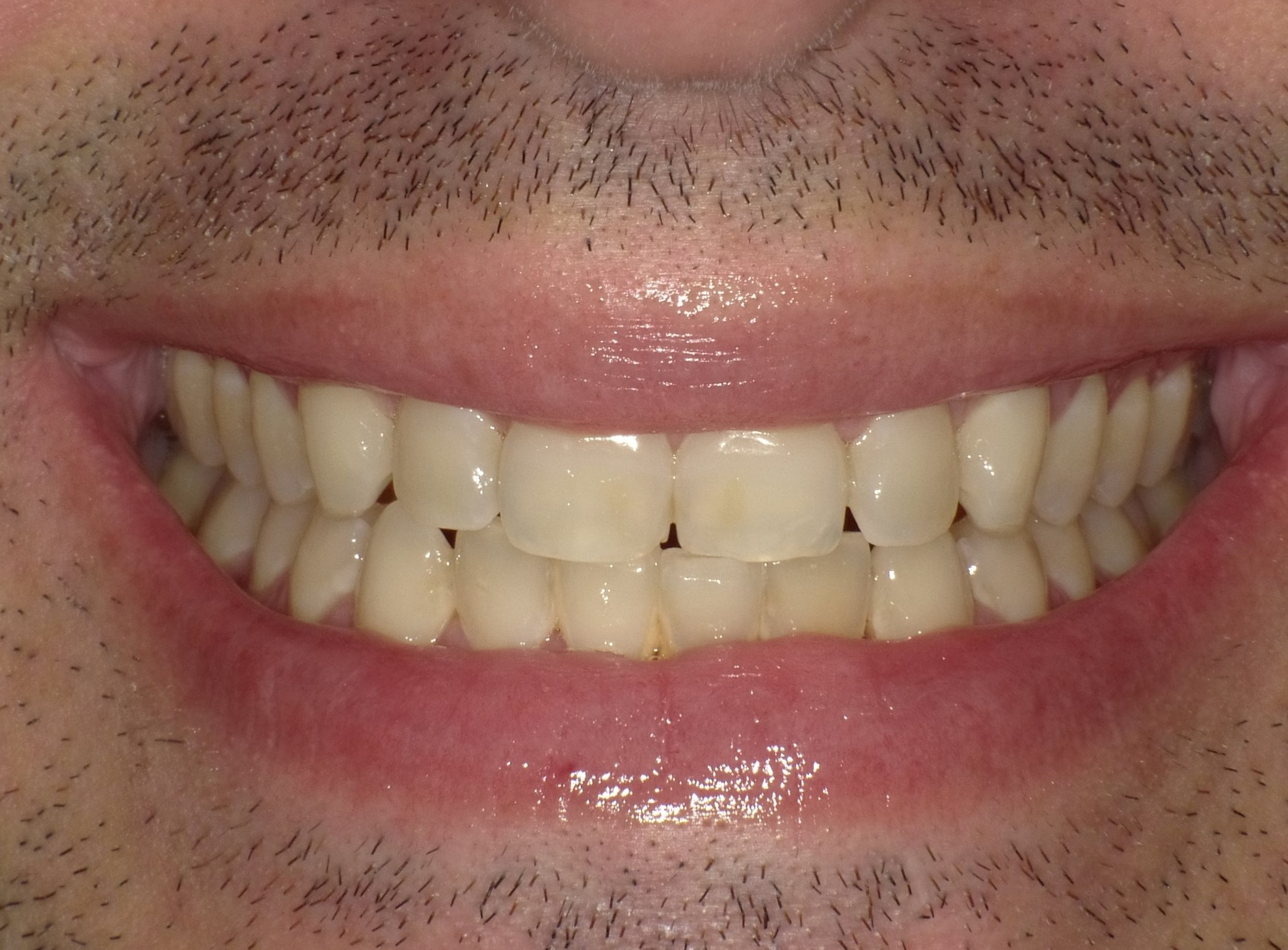 Before Cosmetic Treatment