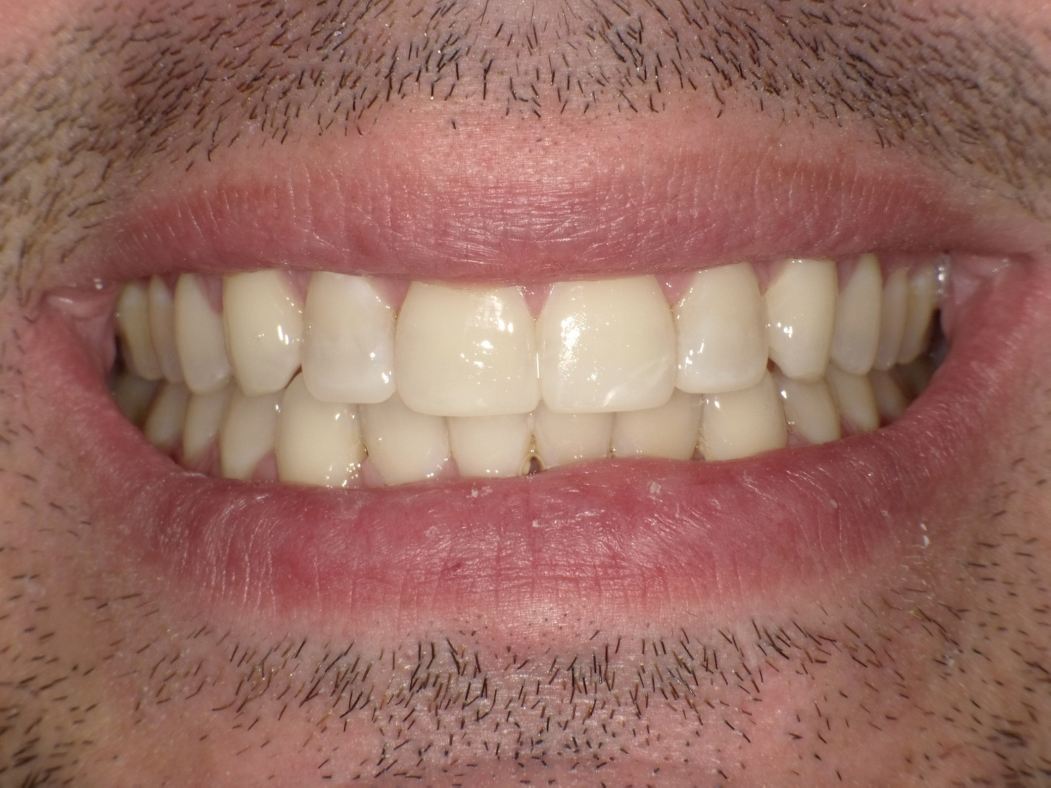 After Cosmetic Treatment