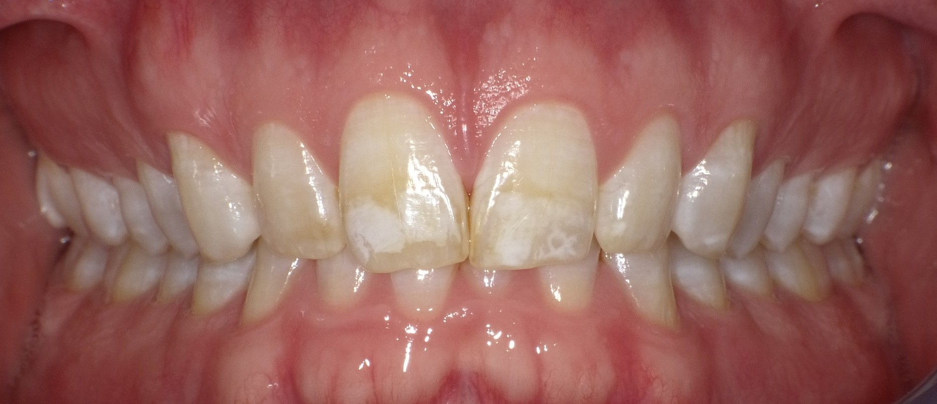 Before Braces Treatment