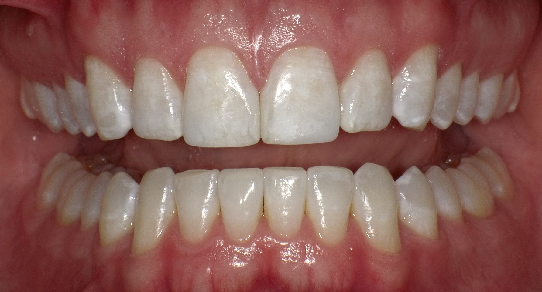 After Braces Treatment