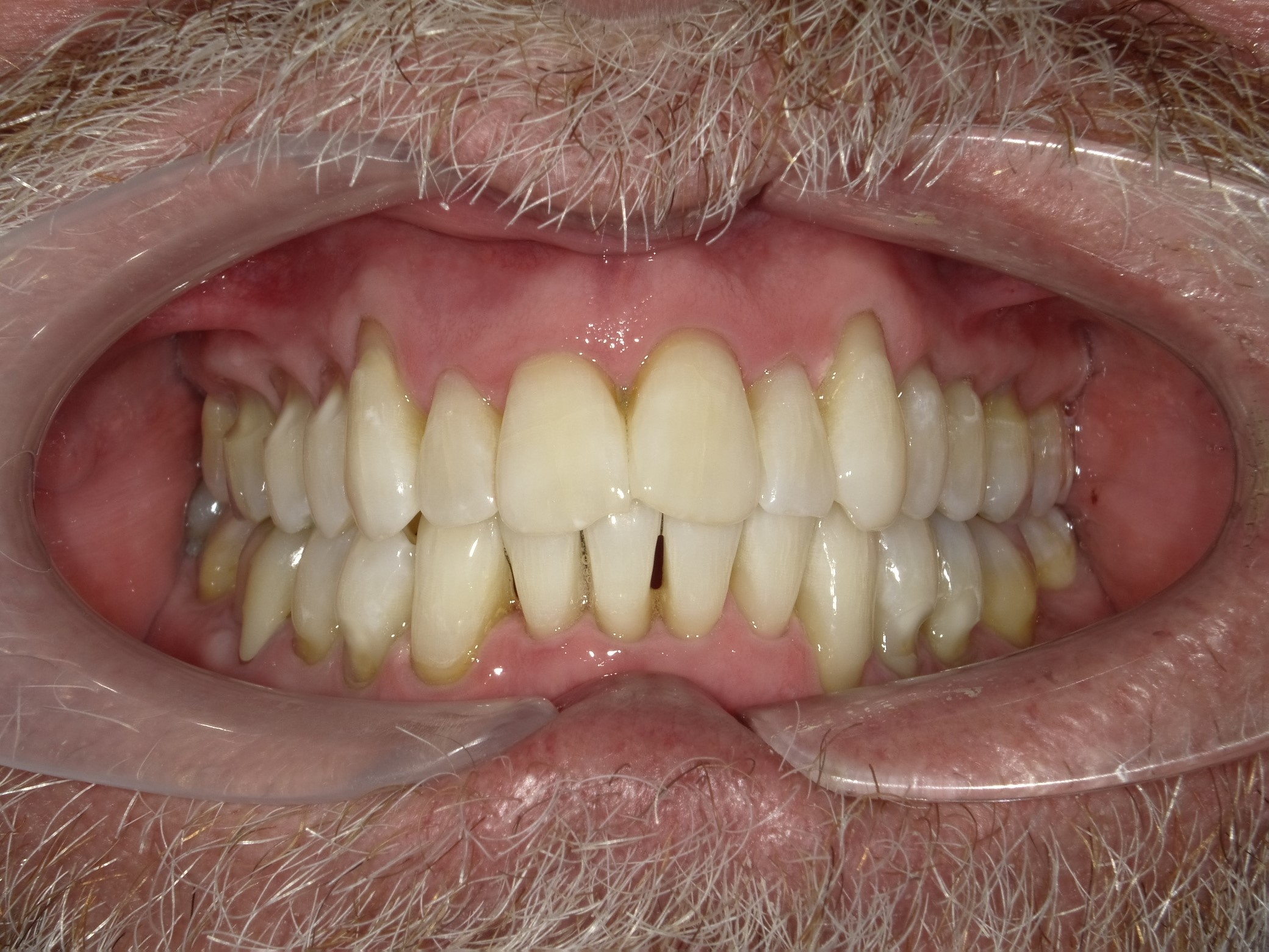 After Veneers