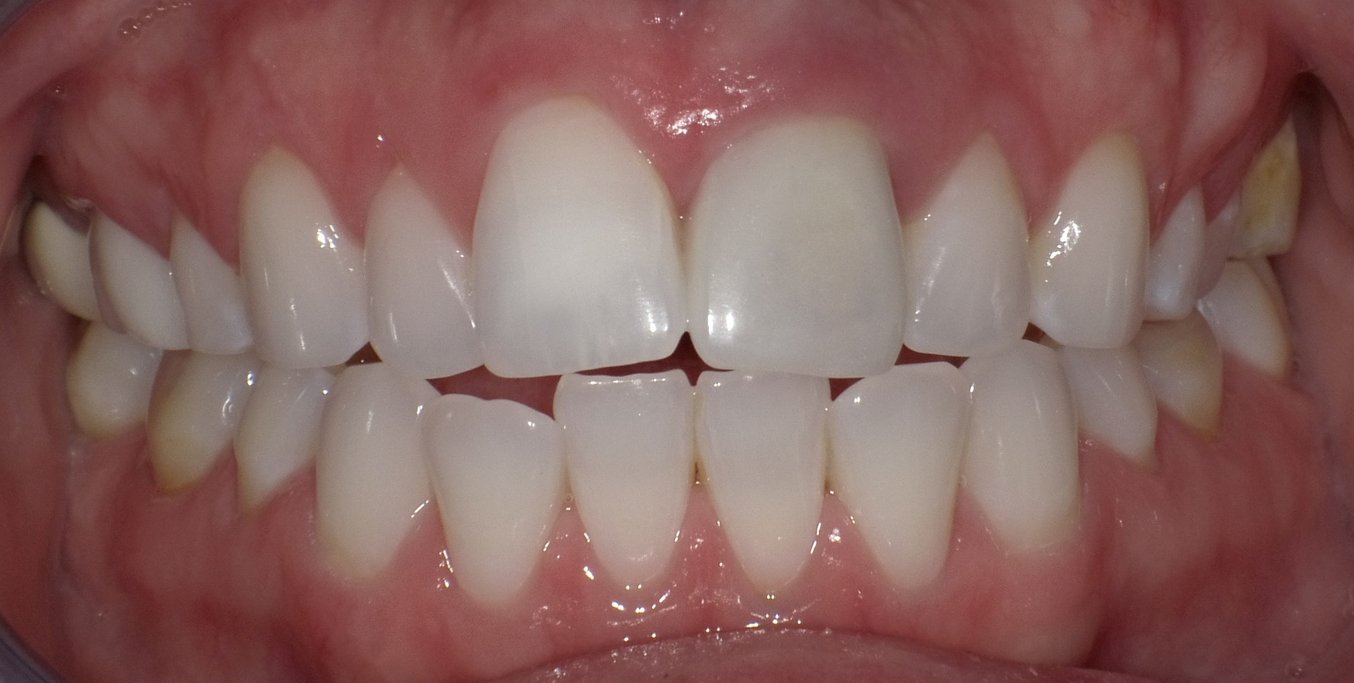 Before Whitening