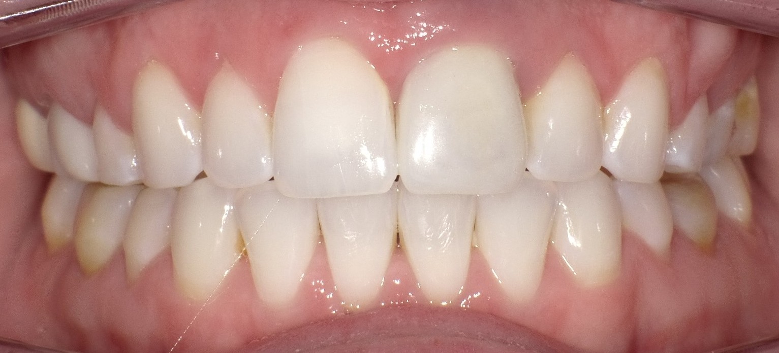 After Whitening